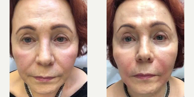 Case 9617 - Woman treated with Thread Lift