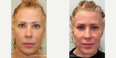 Case 9618 - 45-54 year old woman treated with Thread Lift, Dermal Fillers, Liquid Facelift