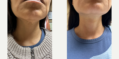 Case 9621 - 65-74 year old woman treated with Thread Lift