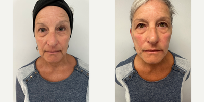 Case 9622 - 55-64 year old woman treated with Thread Lift