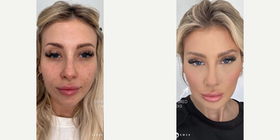 Case 9623 - Woman treated with Thread Lift, Dermal Fillers