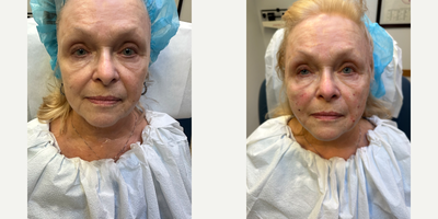 Case 9625 - 65-74 year old woman treated with Thread Lift