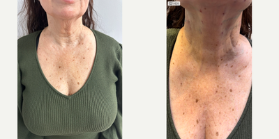 Case 9626 - 55-64 year old woman treated with Thread Lift