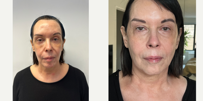 Case 9629 - 45-54 year old woman treated with Thread Lift