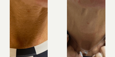 Case 9630 - 35-44 year old woman treated with Thread Lift, Nonsurgical Neck Lift