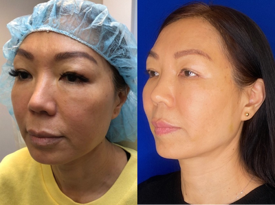 Case 9633 - Woman treated with Thread Lift