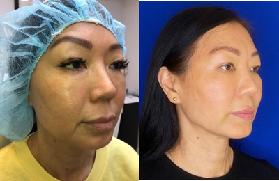 Case 9634 - Woman treated with Thread Lift