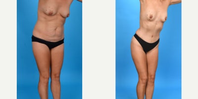 Case 964 - 35-44 year old woman treated with Abdominal Etching, Diastasis Recti Repair, Drainless Tummy Tuck, Liposculpture, Liposuction, M