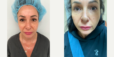 Case 9644 - 45-54 year old woman treated with Thread Lift