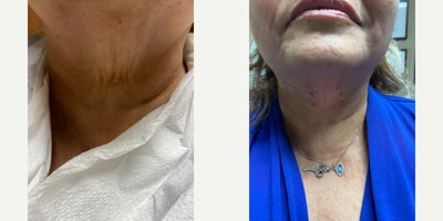 Case 9645 - 65-74 year old woman treated with Thread Lift