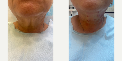 Case 9648 - 55-64 year old woman treated with Thread Lift