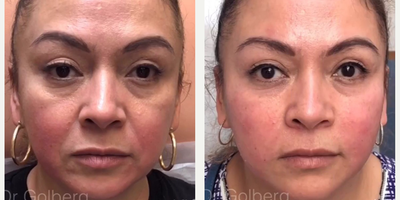 Case 9652 - Woman treated with Thread Lift