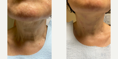 Case 9654 - 55-64 year old woman treated with Thread Lift