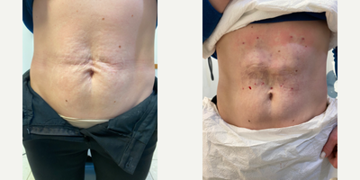 Case 9655 - 35-44 year old woman treated with Thread Lift