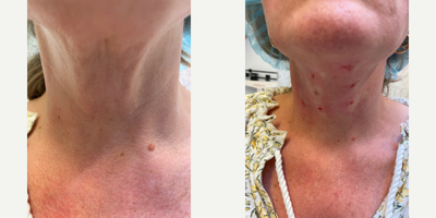 Case 9656 - 35-44 year old woman treated with Thread Lift