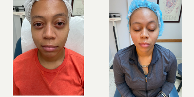 Case 9659 - 25-34 year old woman treated with Thread Lift