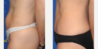 Case 966 - Woman treated with Tummy Tuck