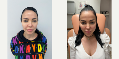 Case 9661 - 25-34 year old woman treated with Thread Lift