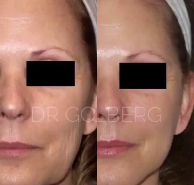 Case 9662 - Woman treated with Thread Lift