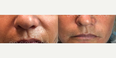 Case 9663 - Woman treated with Thread Lift