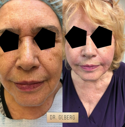 Case 9664 - Woman treated with Thread Lift