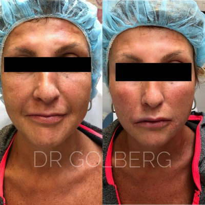 Case 9665 - Woman treated with Thread Lift