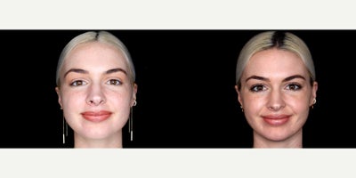 Case 9666 - 27 year old woman treated with Thread Lift