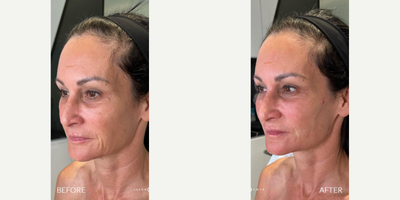 Case 9668 - 45-54 year old woman treated with Thread Lift