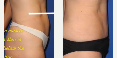 Case 967 - Woman treated with Tummy Tuck