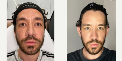 Case: 9674 - before and after photo of THE PERFECT PAIR | HALO AND PRP FOR THE WIN by Jason Emer, MD