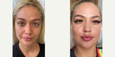 Case: 9675 - before and after photo of 25-34 year old woman treated with CO2 Laser, Halo Laser, TCA Peel by Jason Emer, MD