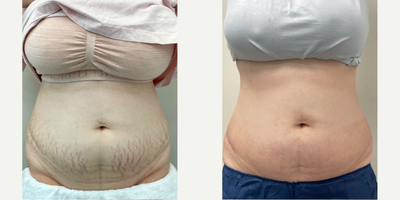 Case: 9676 - before and after photo of 25-34 year old woman treated with Halo Laser by Thomas Buonassisi, MD