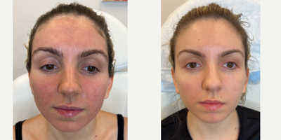 Case: 9677 - before and after photo of ACNE SCAR COMBINATION | HYBRID LASER + CO2 by Jason Emer, MD