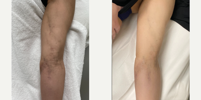 Case: 9678 - before and after photo of 25-34 year old woman treated with Halo Laser, Potenza by Thomas Buonassisi, MD