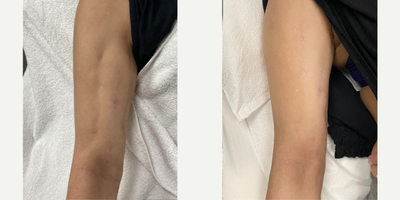Case: 9679 - before and after photo of 25-34 year old woman treated with Halo Laser, Potenza by Thomas Buonassisi, MD