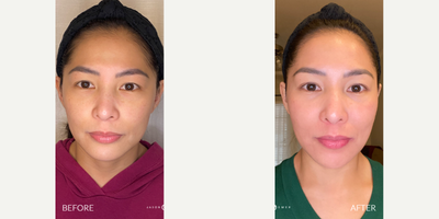 Case: 9680 - before and after photo of 25-34 year old woman treated with Bellafill, Halo Laser, ProFractional Laser by Jason Emer, MD