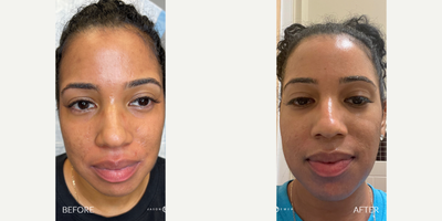 Case: 9681 - before and after photo of 25-34 year old woman treated with Halo Laser by Jason Emer, MD
