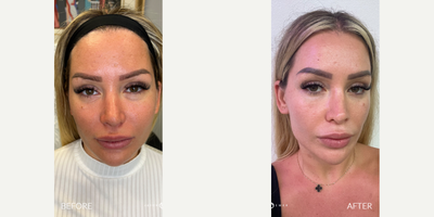 Case 9682 - 25-34 year old woman treated with Halo Laser, Fractional Laser