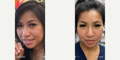 Case 9683 - 25-34 year old woman treated with Halo Laser, CO2 Laser, TCA Peel