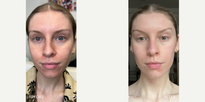 Case 9684 - 25-34 year old woman treated with Halo Laser