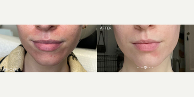 Case 9685 - 25-34 year old woman treated with Halo Laser, Skin Rejuvenation, Laser Resurfacing