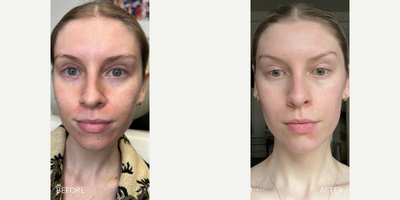 Case 9686 - 25-34 year old woman treated with Halo Laser, Skin Rejuvenation, Laser Resurfacing