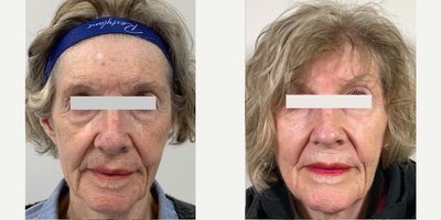 Case 9688 - 65-74 year old woman treated with BroadBand Light (BBL), Halo Laser, Dermal Fillers