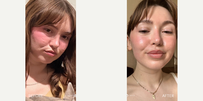 Case 9689 - 18-24 year old woman treated with Halo Laser, Laser Peel, Laser Resurfacing, CO2 Laser