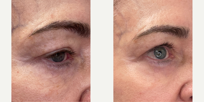 Case 9690 - 65-74 year old woman treated with Halo Laser, ProFractional Laser