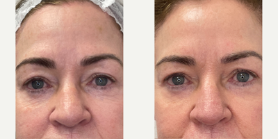 Case 9691 - 65-74 year old woman treated with Halo Laser, ProFractional Laser