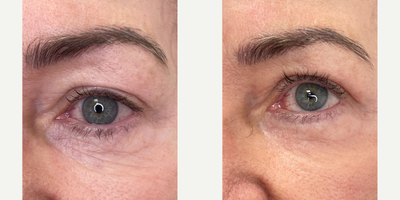 Case 9692 - 65-74 year old woman treated with Halo Laser, ProFractional Laser