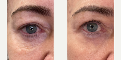 Case 9693 - 65-74 year old woman treated with Halo Laser, ProFractional Laser