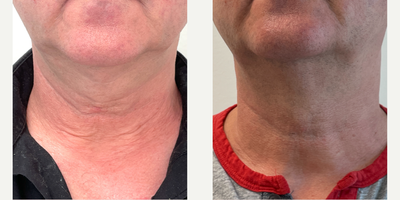 Case 9702 - 55-64 year old man treated with Halo Laser