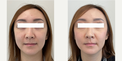 Case 9704 - 35-44 year old woman treated with Halo Laser